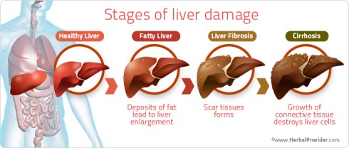 stages-of-liver-damage